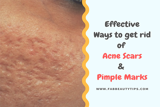 acne scar removal; acne scars; best thing to get rid of acne scars; get rid of acne scars; how to get rid of acne scars; how to remove acne scars; how to remove pimple marks; pimple marks