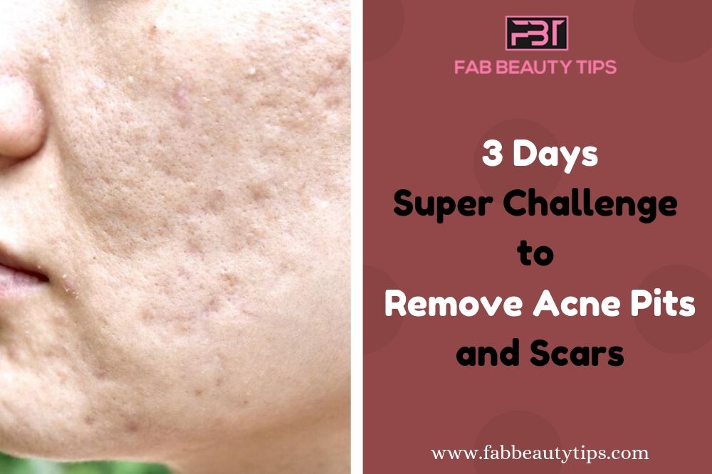 remove acne scars in 3 days, how to remove acne in 3 days, how to remove acne pits in 3 days, how to remove acne scars in 3 days, remove acne in 3 days