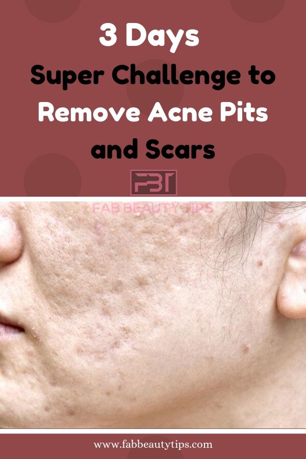 remove acne scars in 3 days, how to remove acne in 3 days, how to remove acne pits in 3 days, how to remove acne scars in 3 days, remove acne in 3 days
