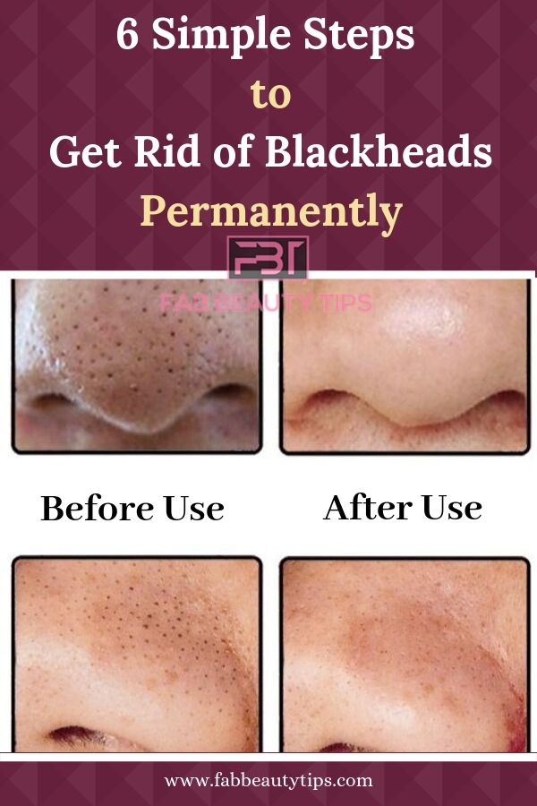 how to get rid of blackheads, get rid of blackheads on nose permanently, get rid of blackheads on nose with toothpaste, six steps to get rid of blackheads