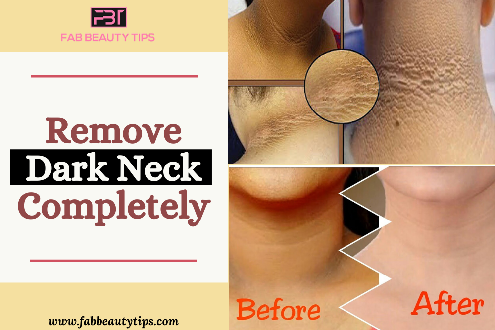 home remedies for black neck, home remedies for dark neck, how to get rid of dark neck fast, how to get rid of dark neck in 20 minutes, get rid of dark neck 
