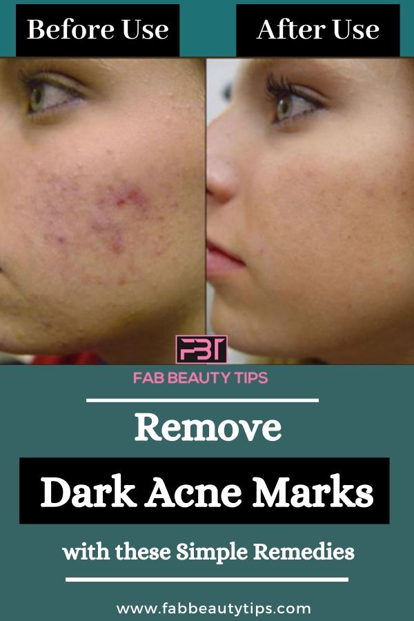 Completely Remove Dark Acne Marks, Remove Dark Acne Marks