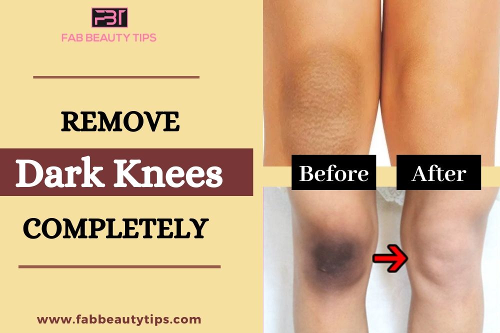 Home Remedies for Dark Knees, Remedies for Dark Knees, get rid of dark knee, dark knee homeremedies, Get Rid of Dark knees in a week