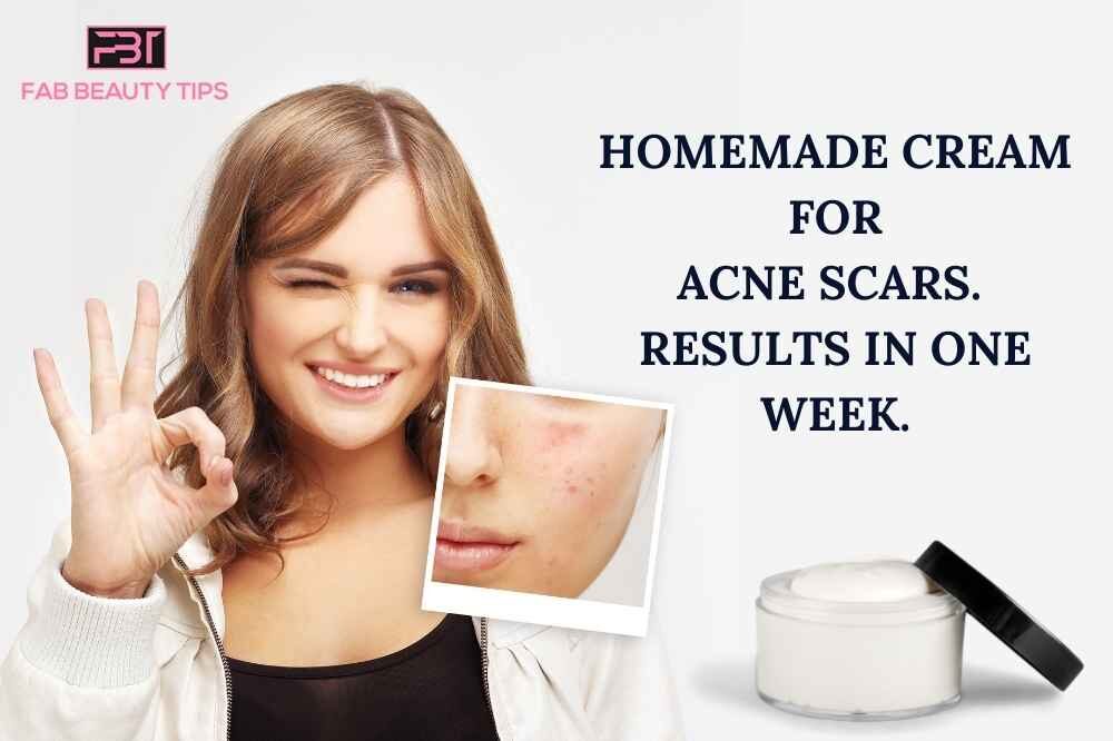 Homemade Cream for Acne Scars, Cream for Acne Scars, Acne Scars cream