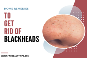 best way to remove blackheads at home; blackhead removal; home remedies to get rid of blackheads; how do you get rid of blackheads; how to get rid of blackheads; how to get rid of blackheads at home