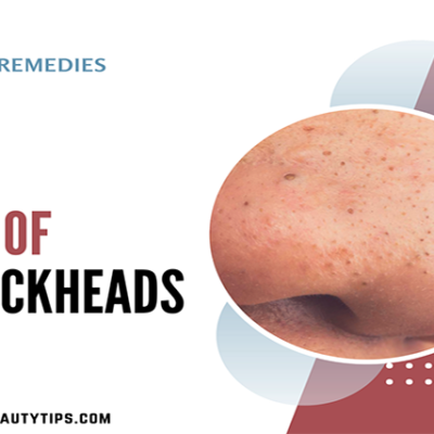 25 Simple home remedies to get rid of blackheads Permanently