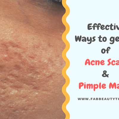 Most Effective Ways to get rid of Acne Scars & Pimple Marks
