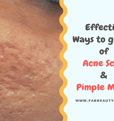 acne scar removal; acne scars; best thing to get rid of acne scars; get rid of acne scars; how to get rid of acne scars; how to remove acne scars; how to remove pimple marks; pimple marks