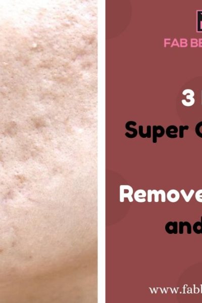 remove acne scars in 3 days, how to remove acne in 3 days, how to remove acne pits in 3 days, how to remove acne scars in 3 days, remove acne in 3 days