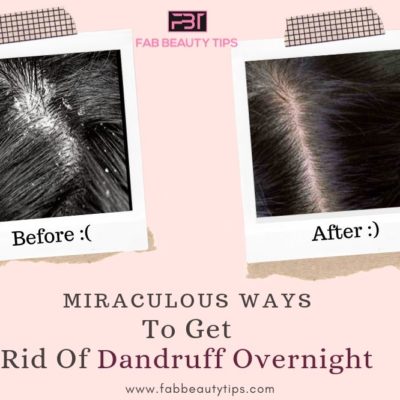 Miraculous Ways to Get Rid of Dandruff Overnight
