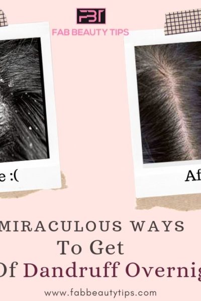 overnight remedy for dandruff, overnight home remedies for dandruff, rid of dandruff overnight, treat dandruff overnight, get rid of dandruff overnight