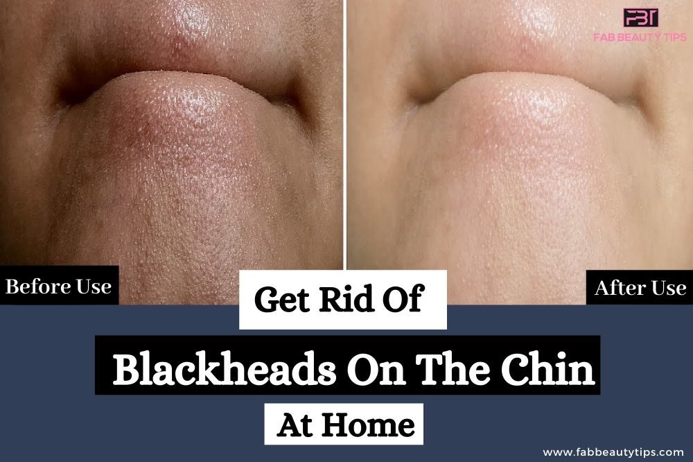 Get Rid Of Blackheads On The Chin At Home, Get Rid Of Blackheads On The Chin, How Get Rid Of Blackheads On The Chin