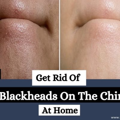 How To Remove Blackheads On Chin At Home
