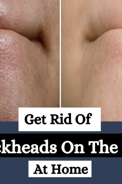 Get Rid Of Blackheads On The Chin At Home, Get Rid Of Blackheads On The Chin, How Get Rid Of Blackheads On The Chin