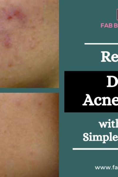 Completely Remove Dark Acne Marks, Remove Dark Acne Marks