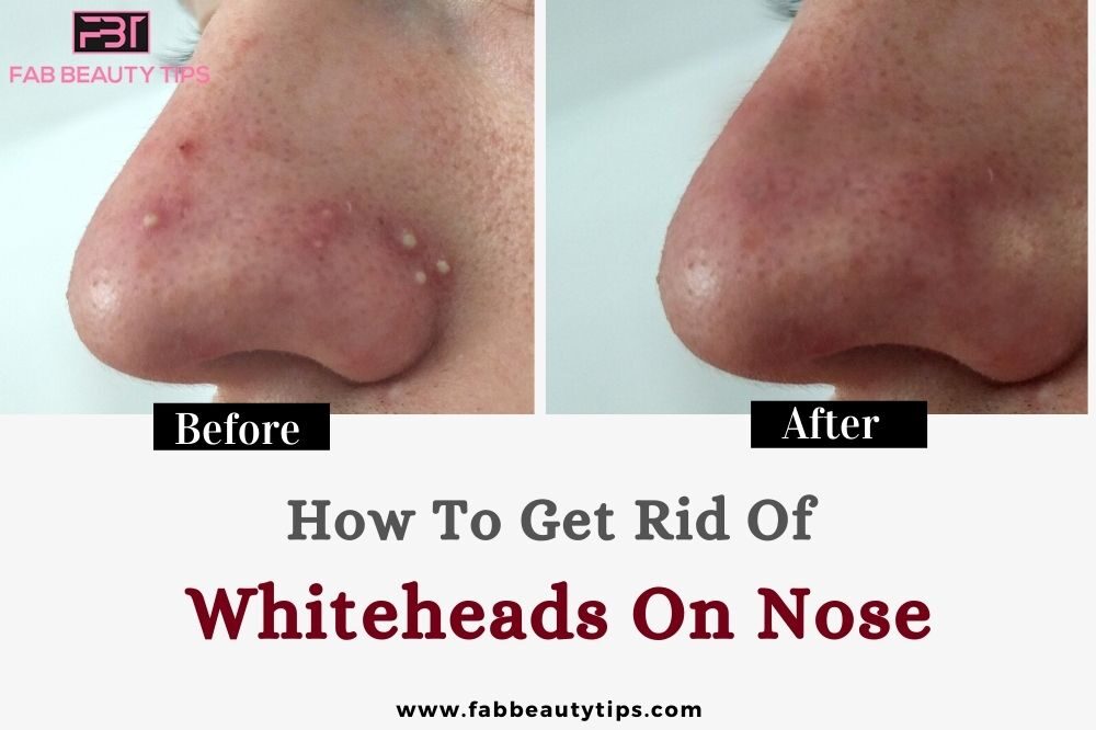 how to get rid of whiteheads on nose, how to get rid of whiteheads on nose naturally,how to get rid of whiteheads on the nose, how to get rid of whiteheads from nose