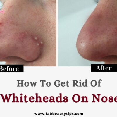 How to get rid of whiteheads on nose